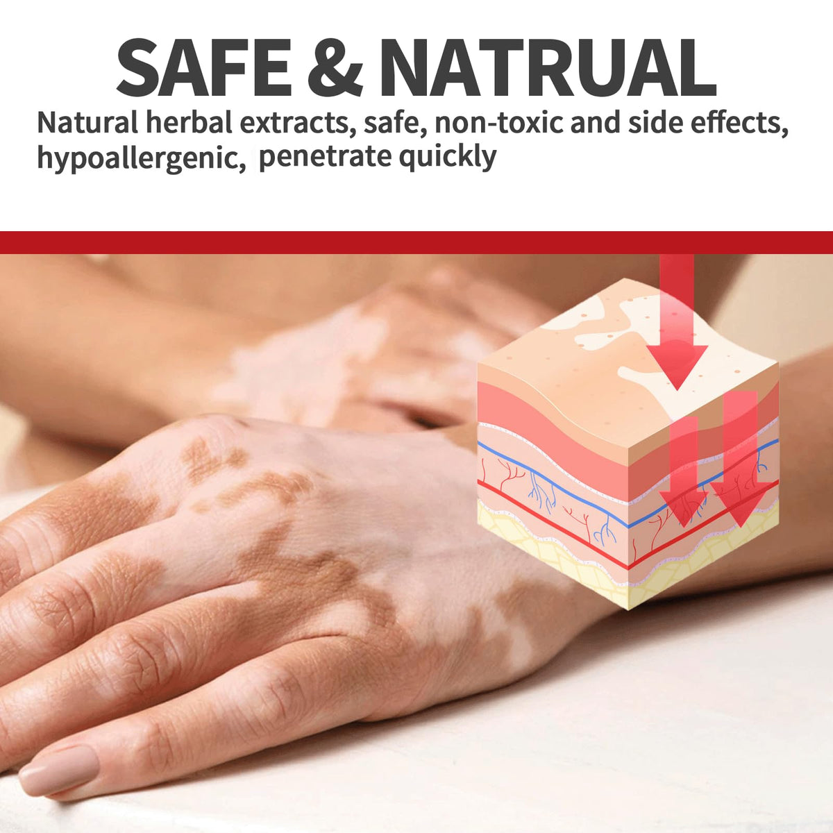 NYYQYYN Vitiligo Treatment packaging box ready for daily use.