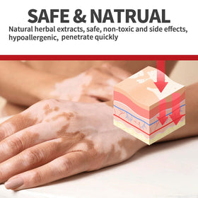 NYYQYYN Vitiligo Treatment packaging box ready for daily use.