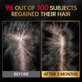 OCSINL Minoxidil detailed dropper label helps correct dosage and routine management