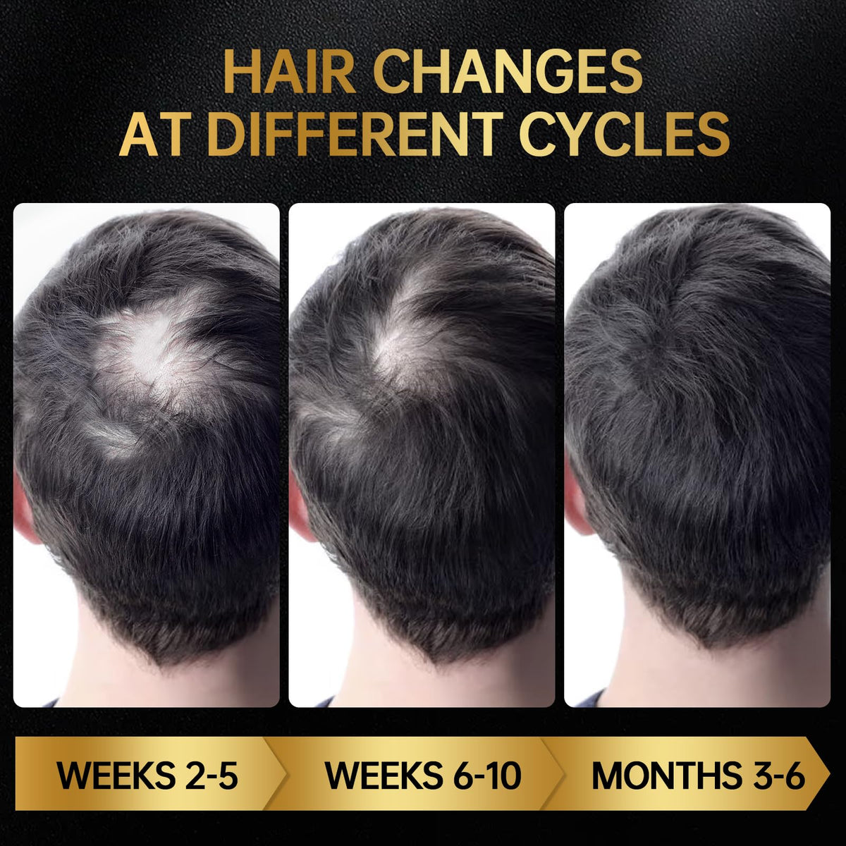 OCSINL Minoxidil scalp massage tip on scalp showing root reach