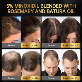 OCSINL minoxidil bottle close-up highlighting non-greasy formula for daily use.