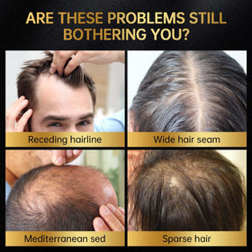 OCSINL minoxidil dropper tip delivering targeted dosing to hair roots.