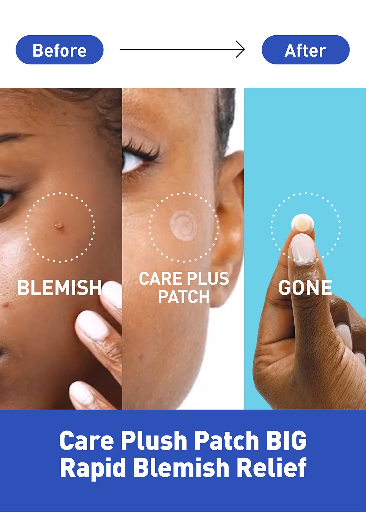 OLIVE YOUNG Care Plus Spot Patch Big on face with invisible coverage