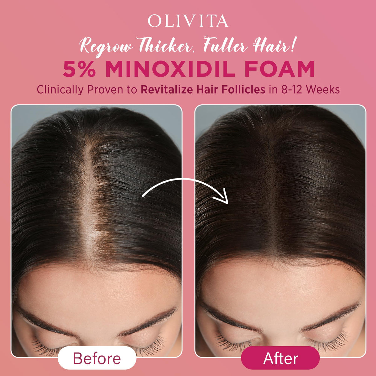 OLIVITA minoxidil foam 5% women fast-drying-texture reduces greasy residue.