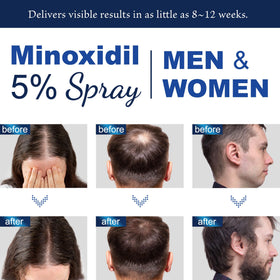 OSIMOON Minoxidil 5% bottle side view with spray nozzle