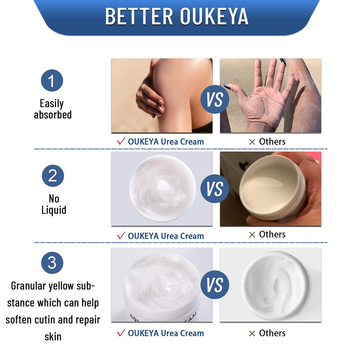 OUKEYA 40% urea cream on hands, nourishing rough skin for daily use.