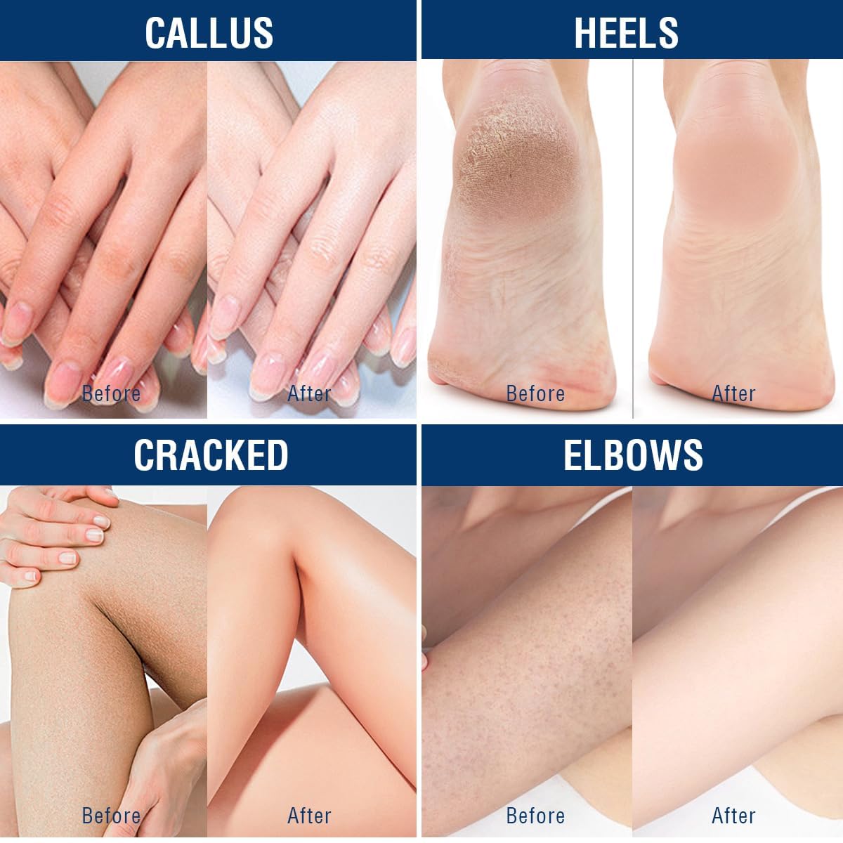 OUKEYA Urea Cream 40% elbows and knees rough skin improvement
