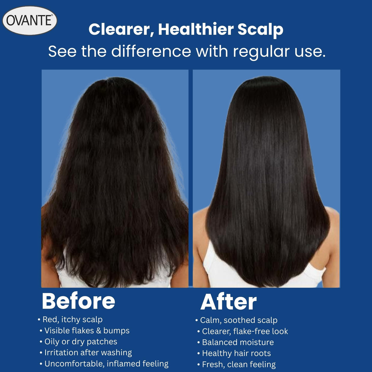 OVANTE packaging box front highlighting product benefits for scalp care.