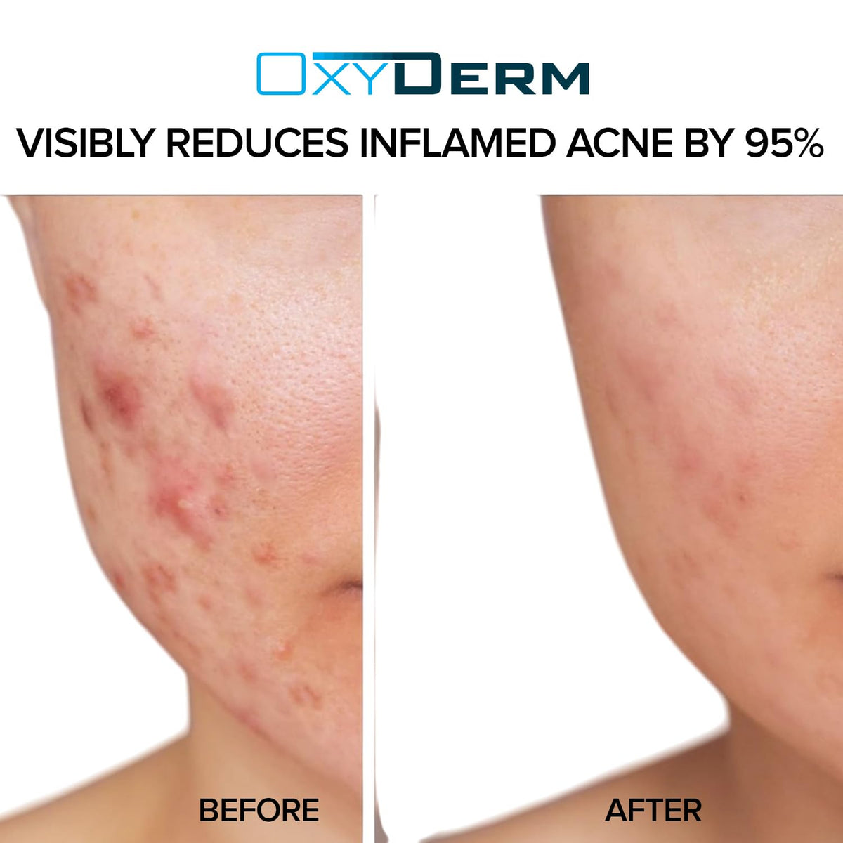 OxyDerm pads on a clean face showing refined texture and reduced oil