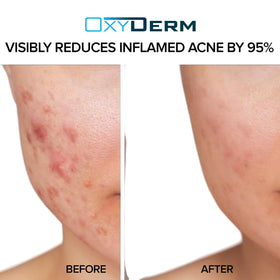 OxyDerm pads on a clean face showing refined texture and reduced oil
