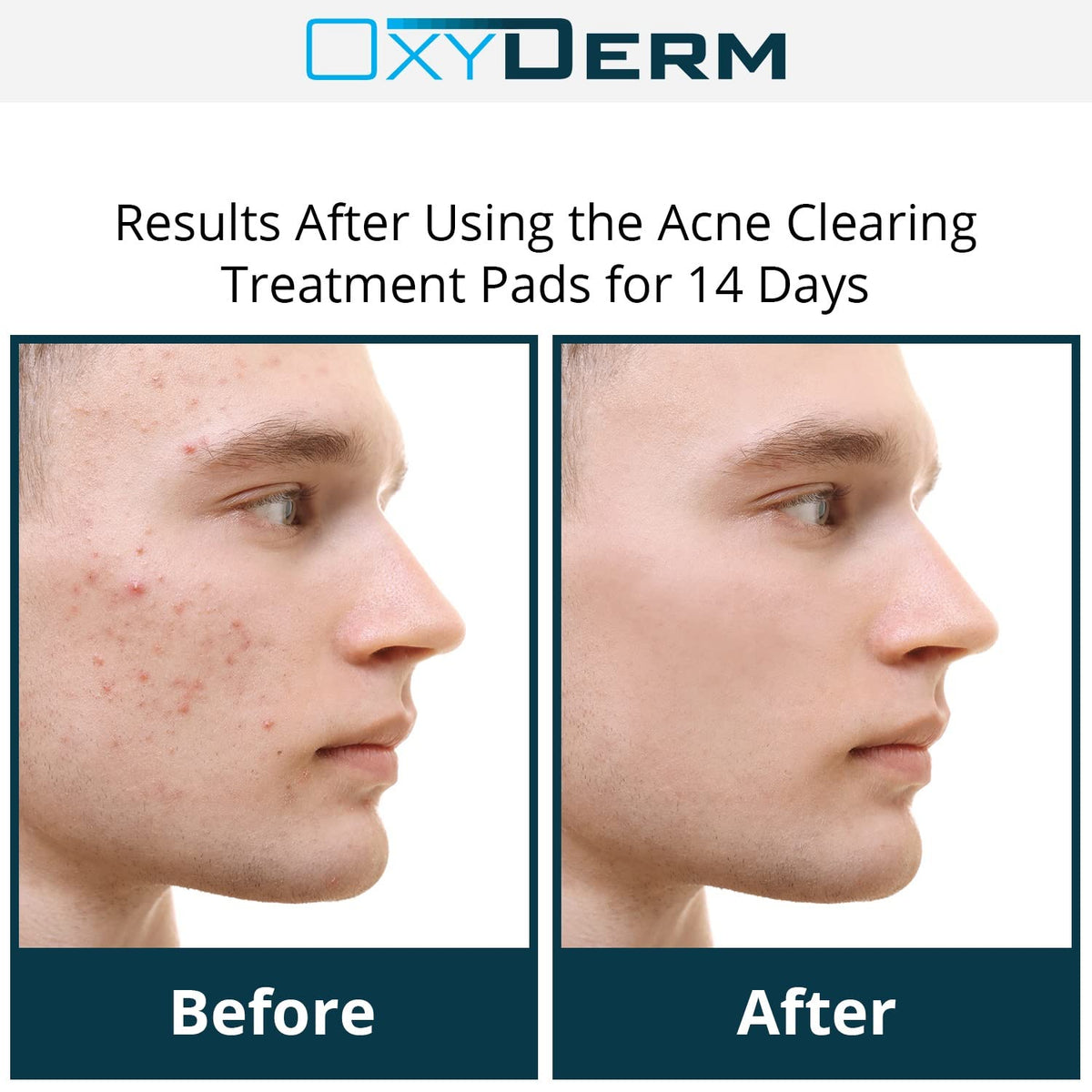 OxyDerm Acne Treatment Pads dual-sided wipe shown for easy daily application