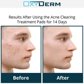 OxyDerm Acne Treatment Pads dual-sided wipe shown for easy daily application