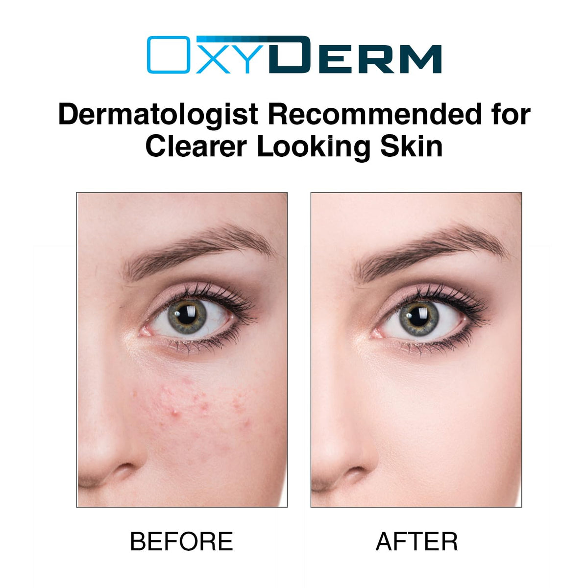 OxyDerm pads balance oil and unclog pores for smoother skin