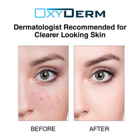 OxyDerm pads balance oil and unclog pores for smoother skin
