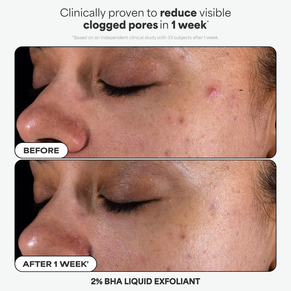 Paula's Choice Azelaic Acid Booster serum promotes even tone and redness reduction potential.