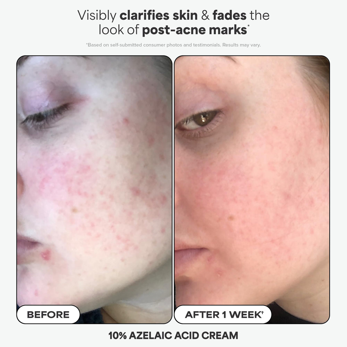 Paula's Choice azelaic acid booster in the mini kit clarifies tone and redness.