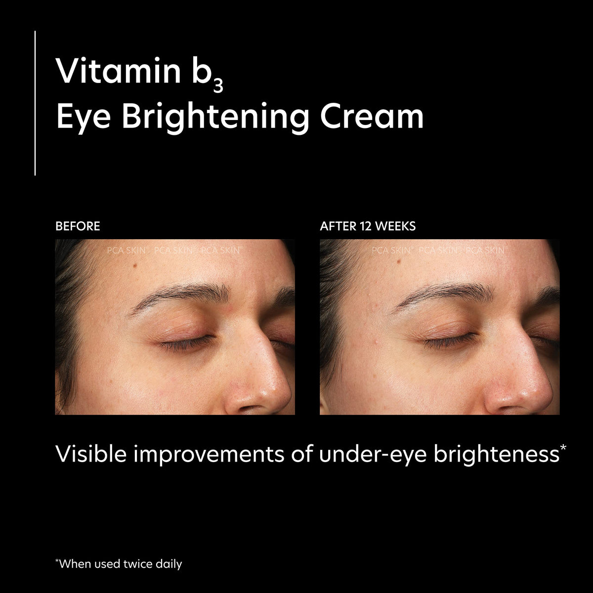PCA SKIN Eye Brightening Cream applied under the eye to reduce dark circles.