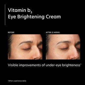 PCA SKIN Eye Brightening Cream applied under the eye to reduce dark circles.