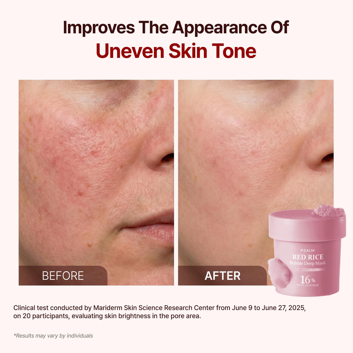 P.CALM Red Rice Bubble Deep Mask carbonated foam on skin during application.
