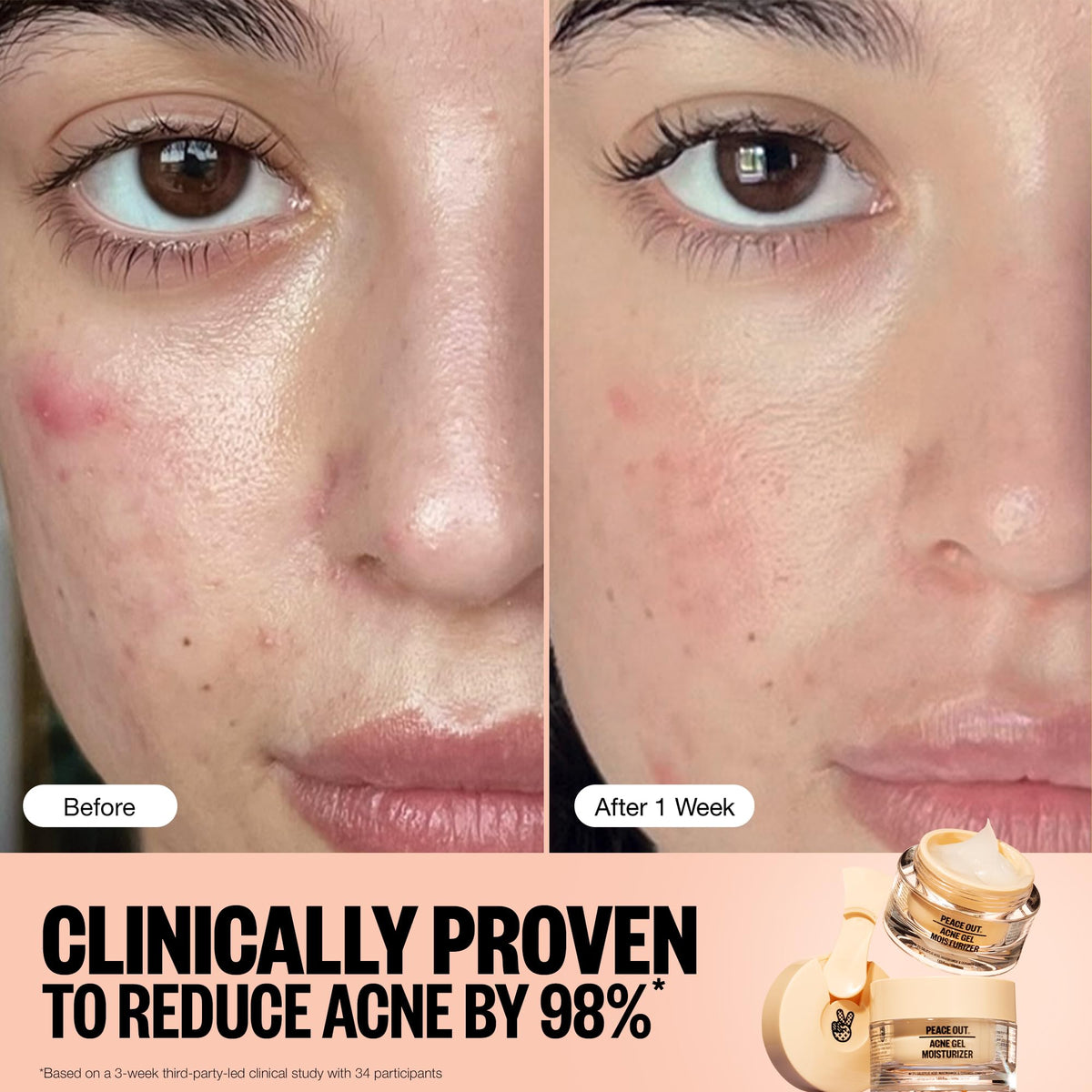 PEACE OUT Acne Gel Moisturizer ingredients-label highlights 2% salicylic acid and ceramides.
