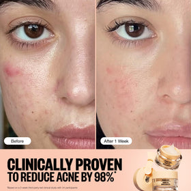 PEACE OUT Acne Gel Moisturizer ingredients-label highlights 2% salicylic acid and ceramides.