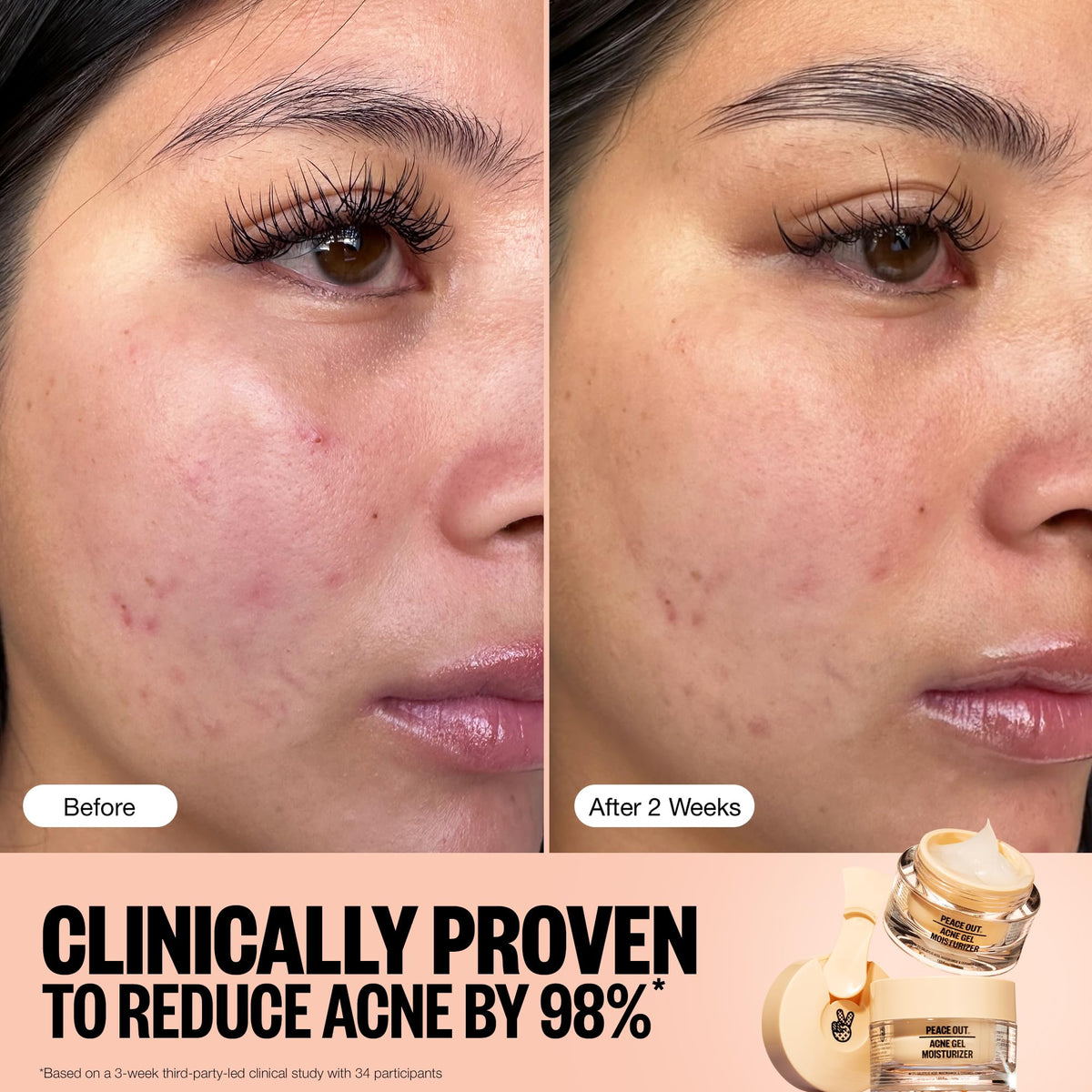 PEACE OUT Acne Gel Moisturizer hibiscus-complex illustration emphasizes deep hydration.