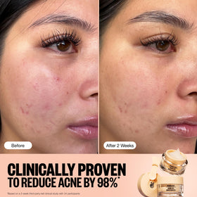 PEACE OUT Acne Gel Moisturizer hibiscus-complex illustration emphasizes deep hydration.