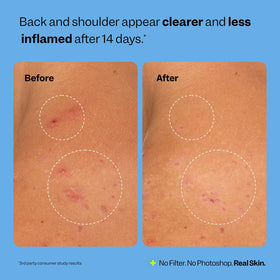 Peach Slices Breakout Banisher beside clean ingredients ideal for sensitive skin