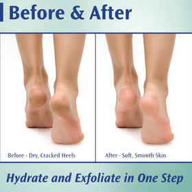 Pedifix extra-strength foot cream demonstrates rich texture for dry, cracked heels at home