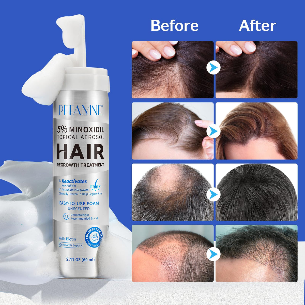 Peesnb minoxidil foam application on scalp demonstrates convenient, fast-absorb formula