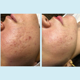 Perfect Image Before-after pores improved with the gel peel.