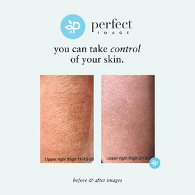 Perfect Image Gly + Sal Exfoliating Lotion arm application; smooth, even coverage.