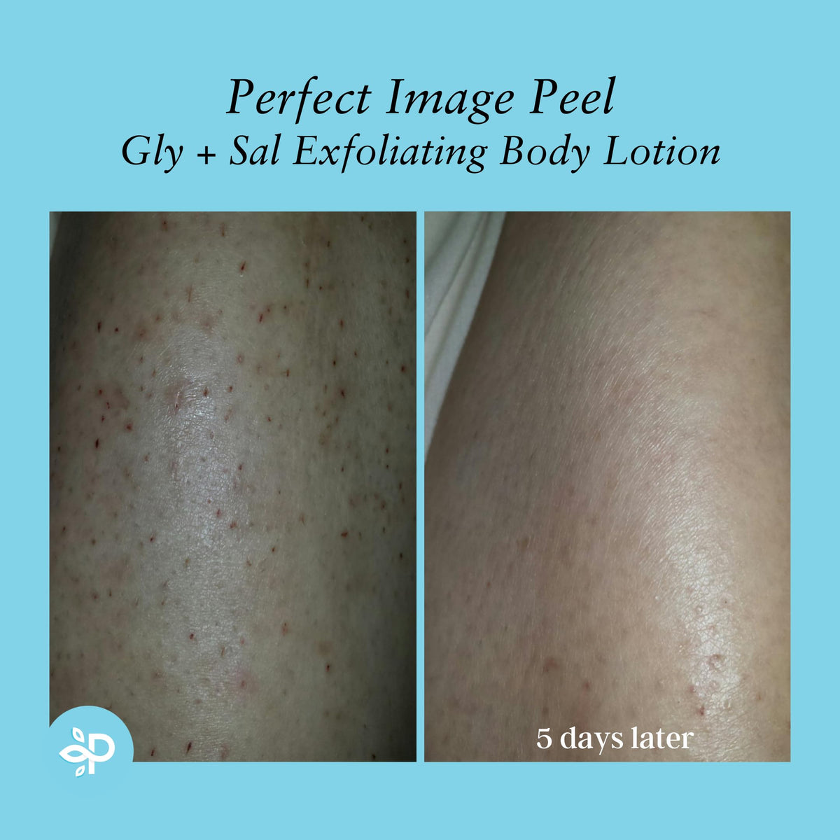 Perfect Image Gly + Sal Exfoliating Lotion spa-scene; salon-like care at home.
