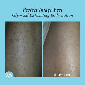 Perfect Image Gly + Sal Exfoliating Lotion spa-scene; salon-like care at home.