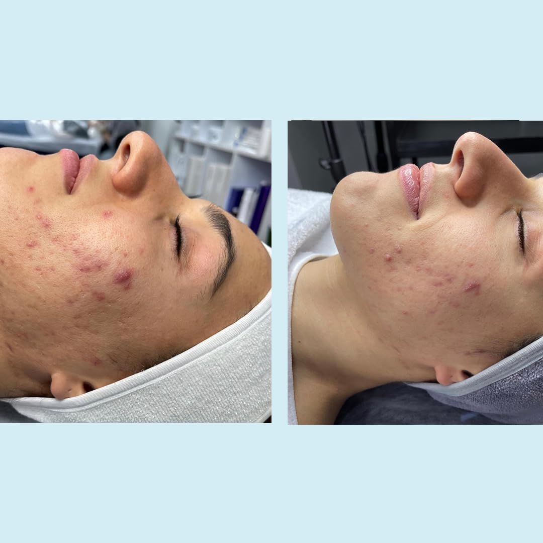 Perfect Image Peel application swatch demonstrates gentle exfoliation.