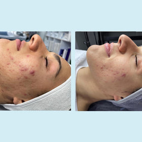 Perfect Image Peel application swatch demonstrates gentle exfoliation.