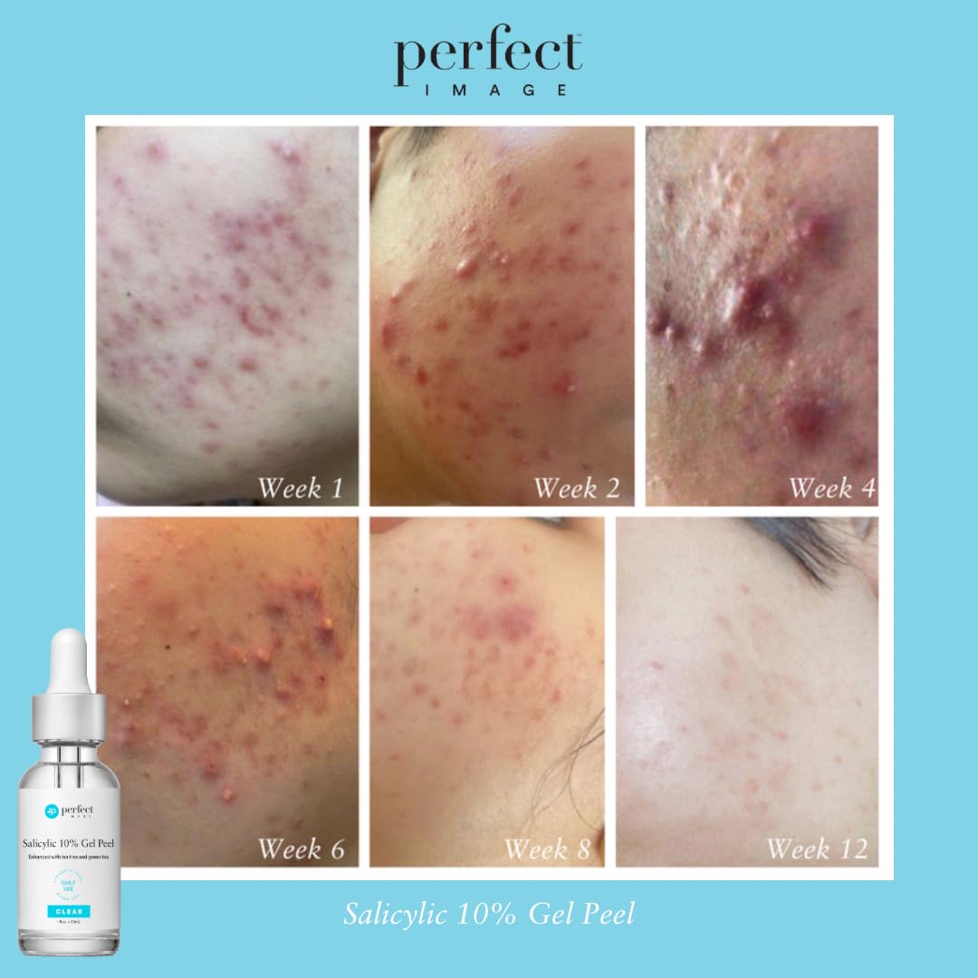 Full-face use demonstration of Perfect Image Salicylic 10% Gel Peel for even coverage
