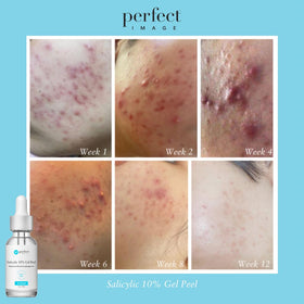 Full-face use demonstration of Perfect Image Salicylic 10% Gel Peel for even coverage