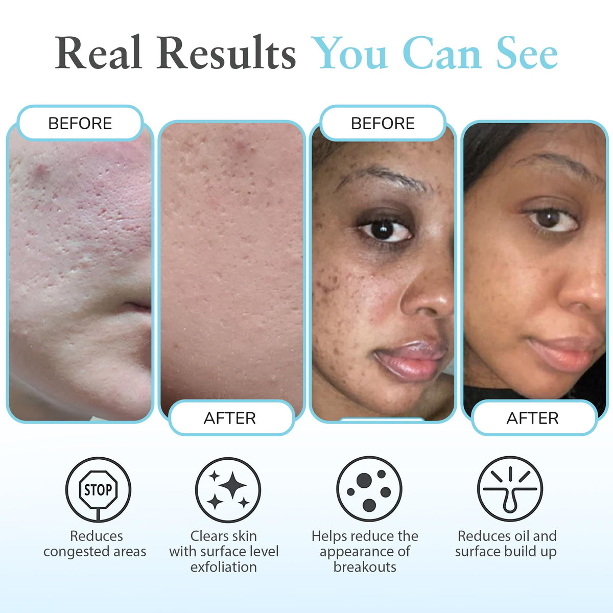 Lightweight application of Perfect Image Salicylic 10% Gel Peel on skin