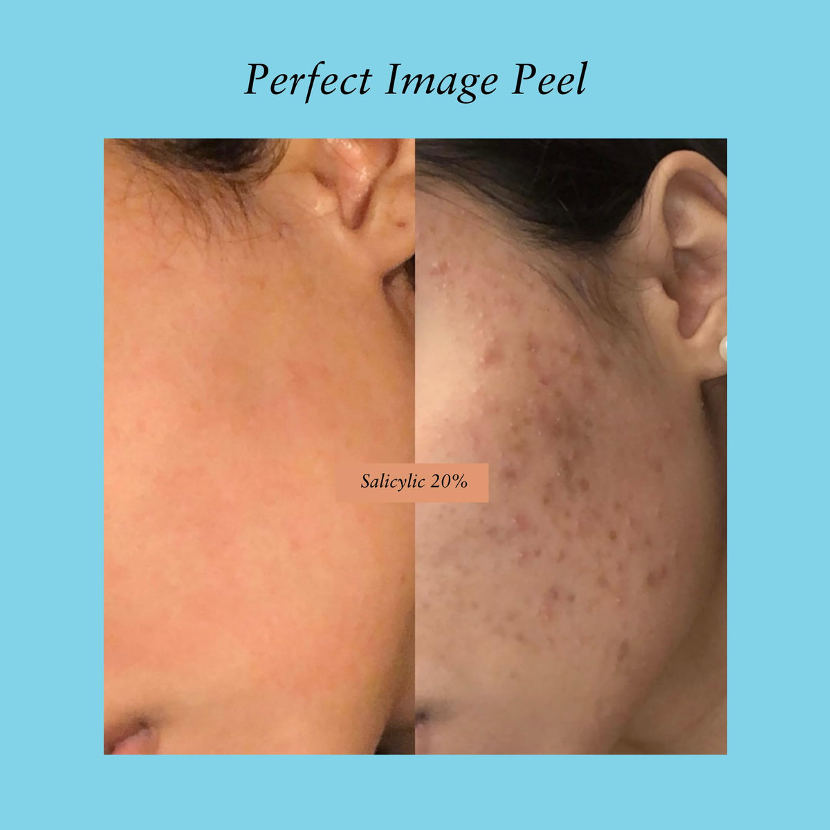 Perfect Image Salicylic Gel Peel packaging communicates premium quality.