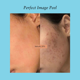Perfect Image Salicylic Gel Peel packaging communicates premium quality.