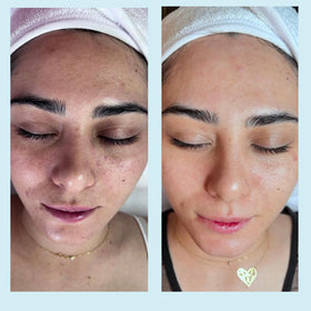 Perfect Image Salicylic Gel Peel close-up of pores showing clarity.