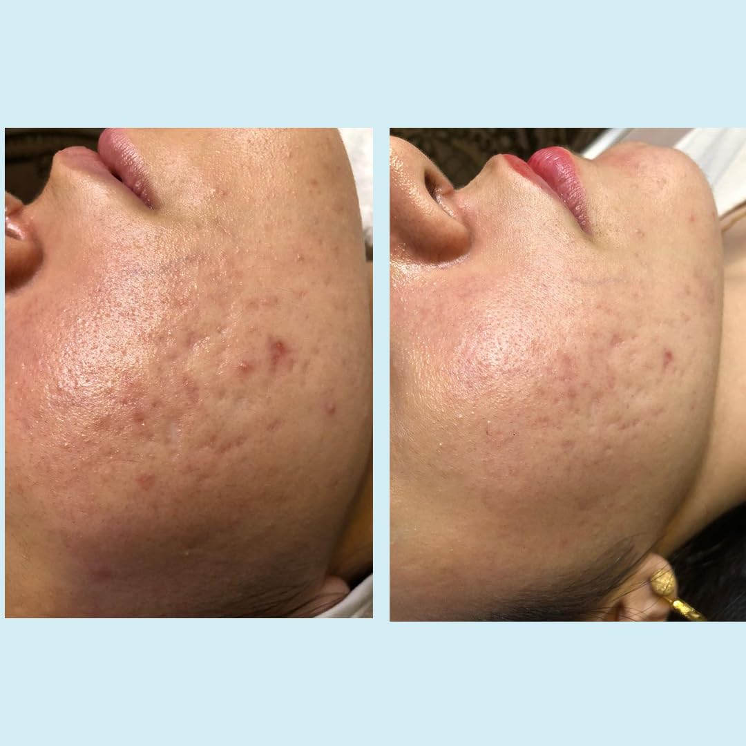 Perfect Image Salicylic Gel Peel with Tea Tree Oil balances oil.