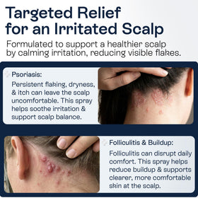 Pharmlitalia 3% salicylic acid formula applied to the scalp