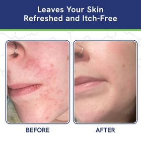 pHat 5.5 soothing cream on hands reduces redness and itch