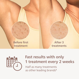 Philips Lumea 8000 SenseIQ sensor ensures safe, skin-aware operation
