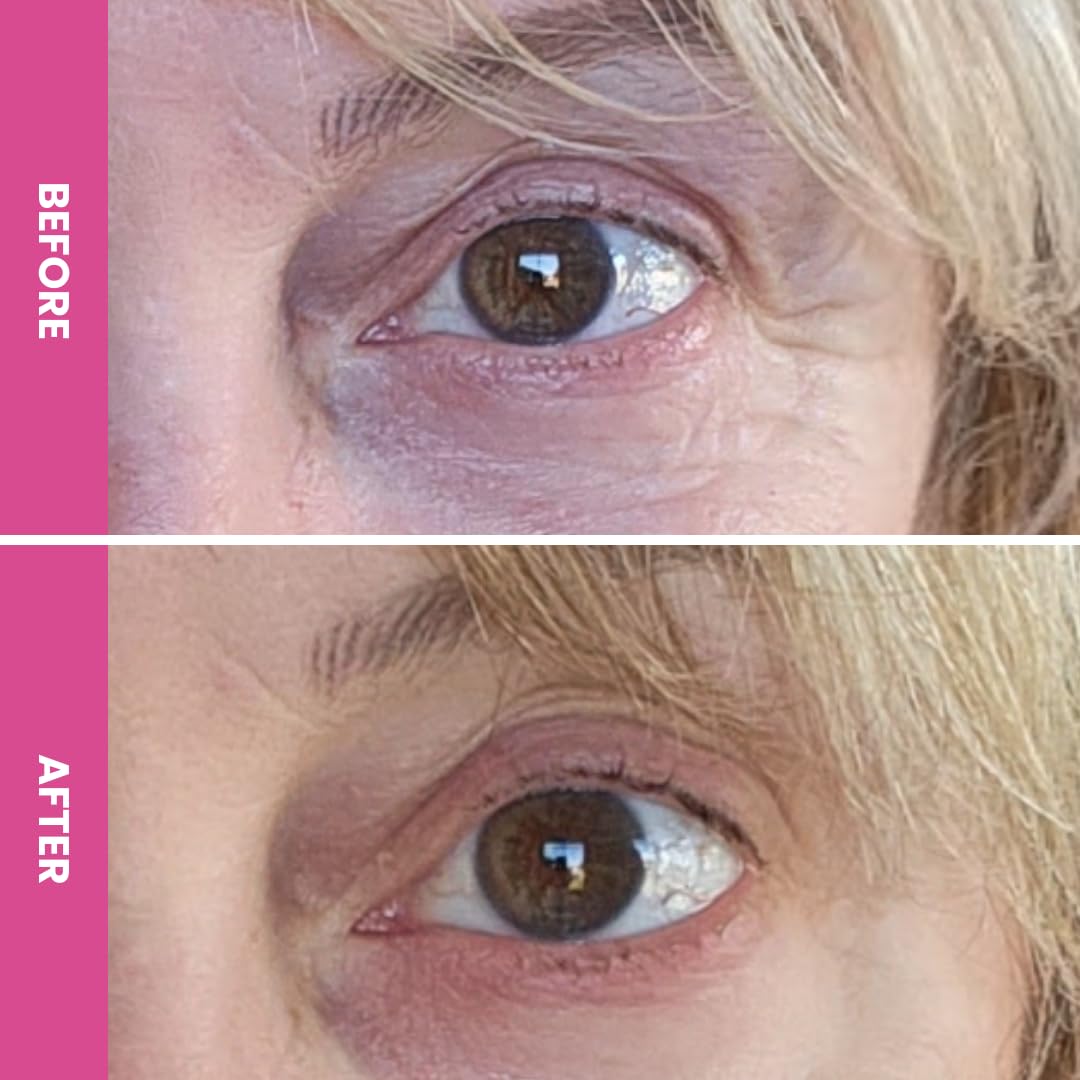 Prime Prometics PrimeEyes Hydrate on orbital area suggesting subtle plumping of lines.