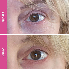Prime Prometics PrimeEyes Hydrate on orbital area suggesting subtle plumping of lines.