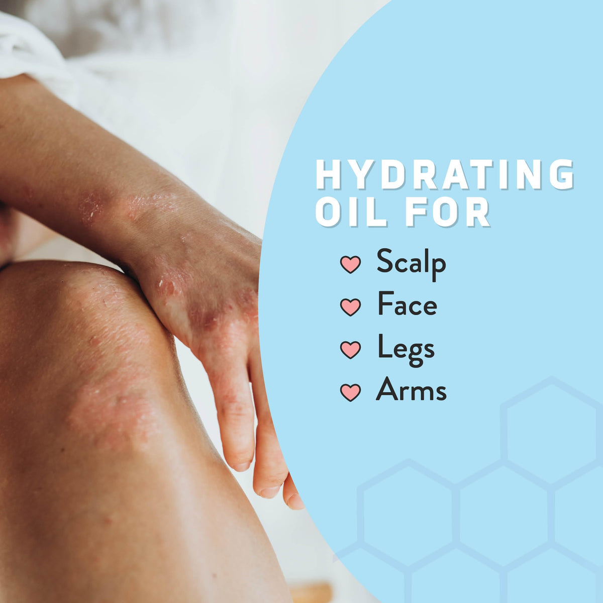 Psoriasis Honey Nourishing Oil application on skin delivers smooth, refreshed feel