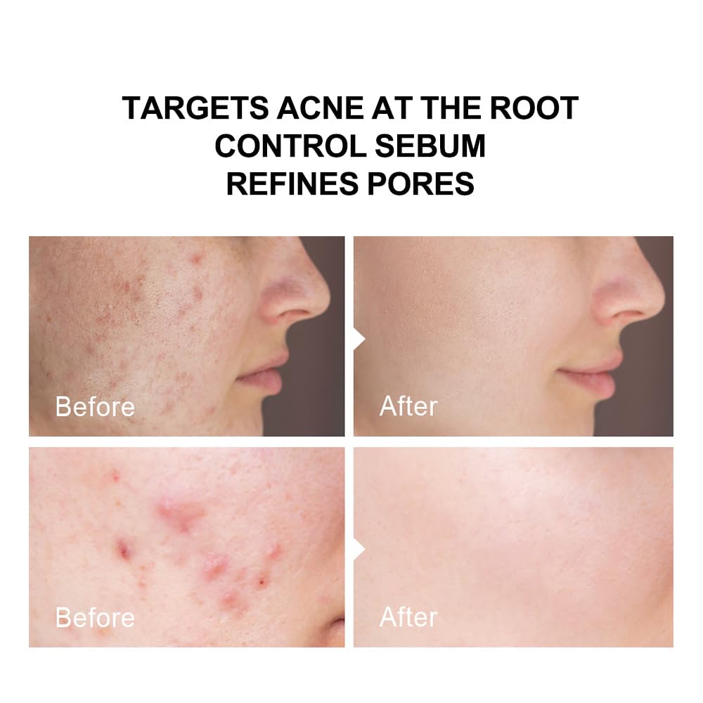 pure.tiful 2% serum on face and back demonstrates versatile acne targeting.